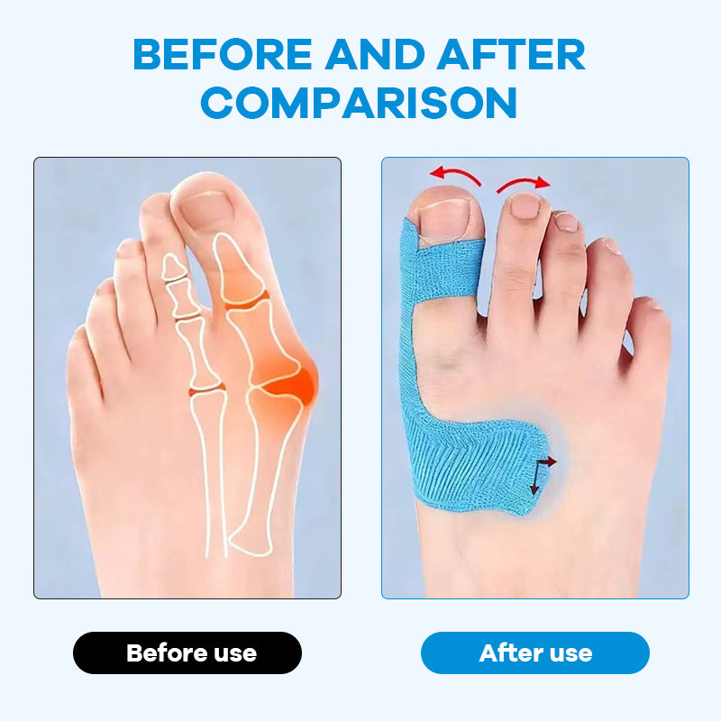 Voorgesneden kinesiologietape voor het corrigeren van hallux valgus